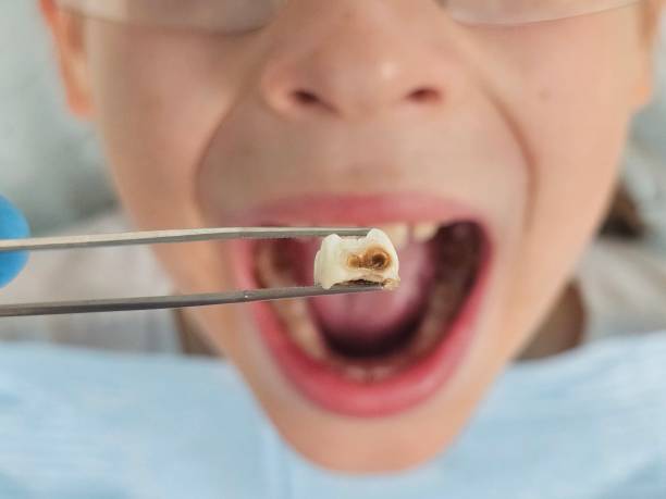 Best Emergency Tooth Extraction in Chatham, VA